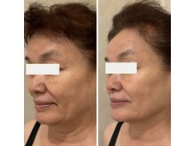 70代ほうれい線／マリオネットライン／ファイラインのたるみ改善