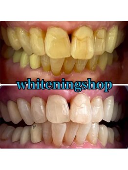 ホワイトニングショップ 武蔵小杉店/【BeforeAfter】13回 施術後比較