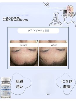 肌イズム 守谷店(肌ism)/【before&after】ダクトピール