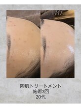 コンクパール(CONCH PEARL.)/陶肌トリートメント