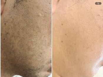 エリクサー 加須店(Elixir)/カミソリ負けも脱毛しておさらば