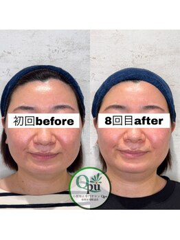 キュープ 相模原淵野辺店(Qpu)/たった4回で人生で1番小さな顔に