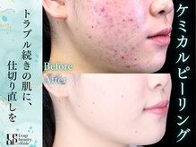 くすみや色ムラを改善し透明感のある均一な肌トーンへ導く施術です