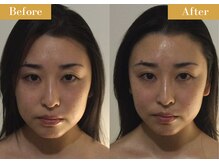 モモスパ(MOMOspa.)/頭蓋骨小顔矯正ビフォアフター