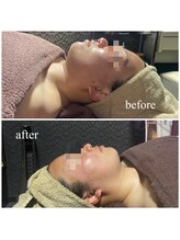 ラクラク(rakuraku)/リフトアップフェイシャル【女】