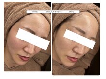 ベルティーク(BELTHEQUE)/肌管理/ララピール/ピーリング