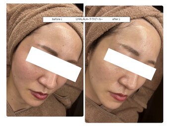 ベルティーク(BELTHEQUE)/肌管理/ララピール/ピーリング