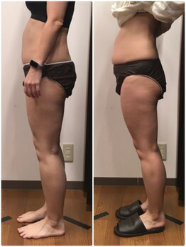 美容整体ユメカ(美容整体YUMEKA)/お腹・脚のラジオ波施術