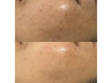 チュチュ(TUTU)/ララピール×美容乳酸菌