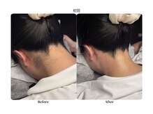 チョクチョクサロン(CHOKCHOK. Salon)/うなじMIX脱毛