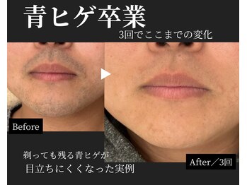 ダイヤ 名古屋中川区店(Daiya)の写真/回数より結果で選びたい方へ｜ヒゲ・vio特化◎回数を無駄にしない結果重視の設計脱毛［完全都度払い］