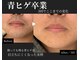 ダイヤ 名古屋中川区店(Daiya)の写真/回数より結果で選びたい方へ｜ヒゲ・vio特化◎回数を無駄にしない結果重視の設計脱毛［完全都度払い］