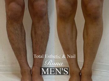ルーナ(Runa)/メンズ脱毛【ヒザ下脱毛】¥7700