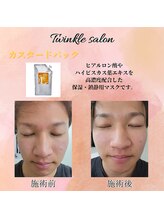 ティンクル サロン(Twinkle salon)/顔脱毛後にカスタードパック
