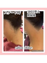 サロンシャイン(Salon Shine)/うなじ脱毛のデザイン