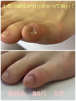 巻き爪じゅん 千葉駅前店/小指の爪の端が分離して分厚く