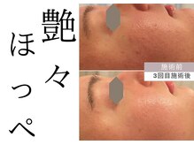 チッチ アフロディーテ(Chicchi Aphrodit)/毛穴洗浄＋ハーブピーリング