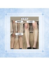 テトテ(tetote)/脚脱毛