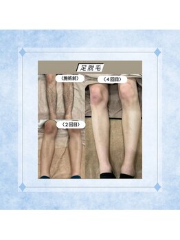 テトテ(tetote)/脚脱毛