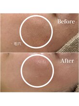 ジョアアンジェ 京橋店(joie ange)/毛穴ケア