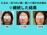 50代後半限定【見た目年齢を変える美顔鍼！】5ヶ月集中コースお試し