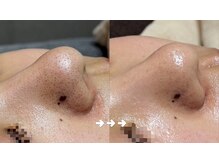 フロラスキン 銀座Miel店(florasKIN)/毛穴洗浄コース