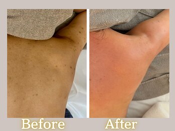 ハル(HARU.)/背中・二の腕ニキビケア