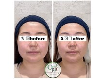 キュープ 相模原淵野辺店(Qpu)/たった4回で人生で1番小さな顔に