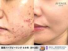 アベニール 芦屋の雰囲気（国産ハーブピーリングでニキビ肌を根本改善！都度払いOKで安心）