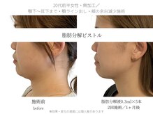 サボラミ(sabor A Mi)/DT・痛み最小限でスッキリ小顔に