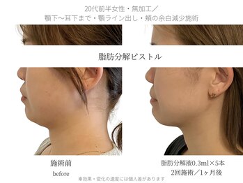 サボラミ(sabor A Mi)/DT・痛み最小限でスッキリ小顔に