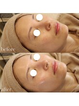 メゾリーナ(MAISOReNA)/水光ピール&エクソソーム