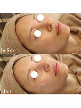 メゾリーナ(MAISOReNA)/水光ピール&エクソソーム