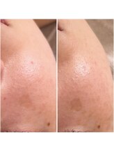 プリュムアイ フェイシャルホーム(prume eye.facial home)/ハーブピーリング