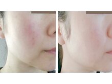 エン(O'en)/ヒト幹細胞炭酸パック