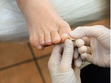 厚木 海老名 巻き爪矯正センター/施術【2.テープ貼付】