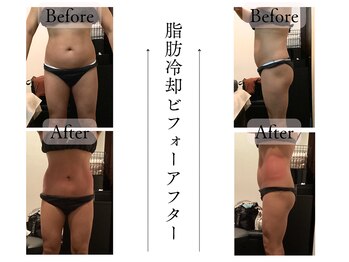 クローネ(Krone)/脂肪冷却ビフォーアフター