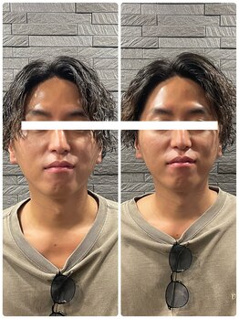 長寿鍼灸院 長寿整骨院/men's美容鍼50本効果★