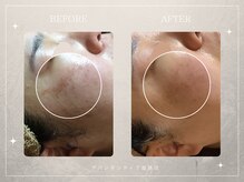 アバンダンティア 姫路店/広範囲のシミにも