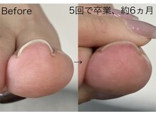 ロンディネ(Rondine)/巻き爪ケア/ネイルトリム9