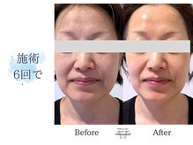 ディアスマイル(Dear.smile)/施術6回で
