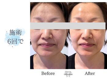 ディアスマイル(Dear.smile)/施術6回で