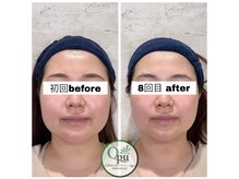 キュープ 相模原淵野辺店(Qpu)/たった4回で人生で1番小さな顔に