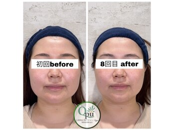 キュープ 相模原淵野辺店(Qpu)/たった4回で人生で1番小さな顔に