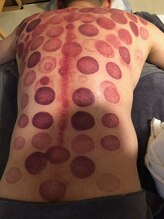 中国整体 らくらく堂/上半身デトックス温かい吸い玉