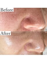 ドレッサー(Dresser)/驚くほど毛穴が肌が変わった