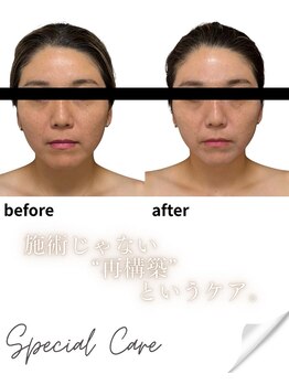 リノン(LIINON)/施術じゃない。再構築というケア