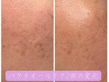 マヨズサロン(Mayo’s salon)/バクチオールケアでの変化
