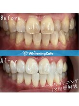 ホワイトニングカフェ 上田店/ホワイトニングビフォーアフター