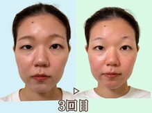 ナチュラルビューティーフェイス 横浜(NBF)/歪み・表情筋を整える